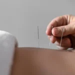 Needle therapy for back pain.